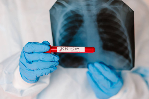Doctor specialist pulmonary medicine holding radiological, chest x-ray film for medical diagnosis on patient health on infected coronavirus. A hands hold a test tube with biological sample blood. - Photo, image