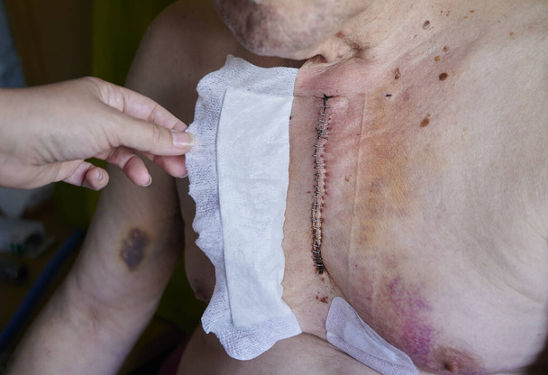 alter operierter Mann zeigt seine Operation an der Brust, wo der Schlitz den Bruch des Brustbeins zeigt - Foto, Bild