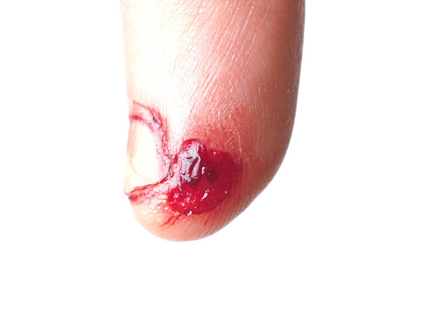 mužský prst s roztrženou krvácející kůží (zranění, první pomoc) - Fotografie, Obrázek