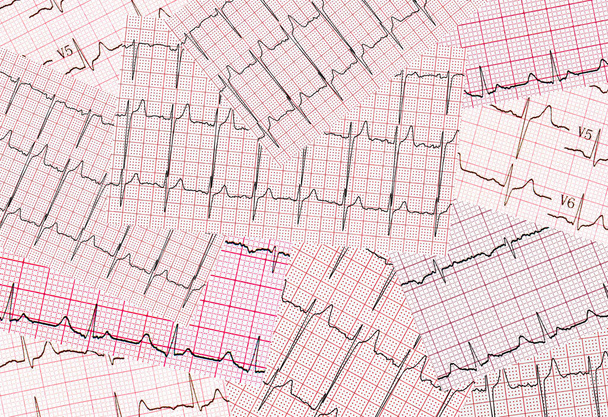 A kardiogram sok nyomtatott eredménye kaotikus. Absztrakt háttér - Fotó, kép