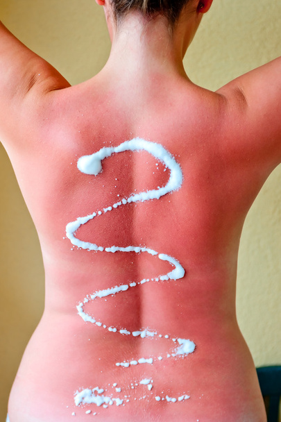 After-Sun crème op haar rug - Foto, afbeelding