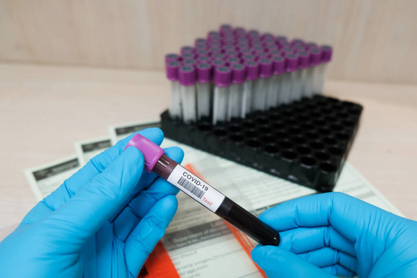 Test sanguin Covid-19 en laboratoire hospitalier
  - Photo, image