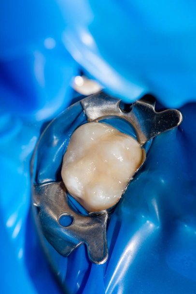 close-up behandeling van een menselijke tand met behulp van een blauw rabberdamsysteem en een tandspiegel. Esthetische tandheelkunde, hygiëne - Foto, afbeelding