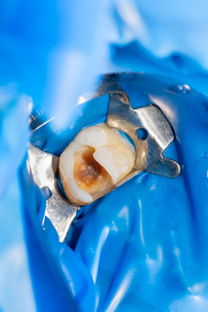 tratamiento de cerca de un diente humano utilizando sistema rabberdam azul y un espejo dental. Odontología estética, higiene
 - Foto, imagen