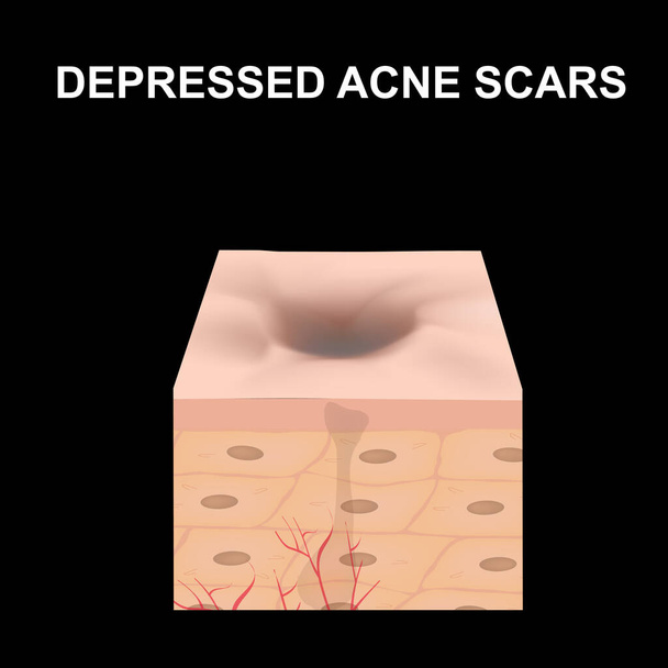Atrofische littekens. Een acne litteken. De anatomische structuur van de huid met acne. Vectorillustratie op geïsoleerde achtergrond. - Vector, afbeelding