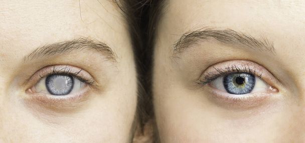 Person with white pupil and healthy eye comparison close up - Fotó, kép