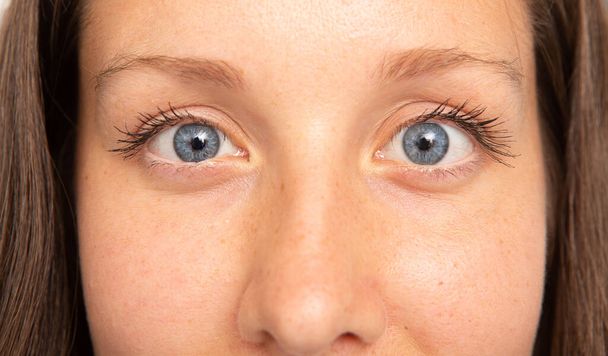A closeup view of a young and pretty Caucasian woman with blue eyes, suffering from strabismus. A condition that causes the eyes not to align with each other. - Foto, immagini