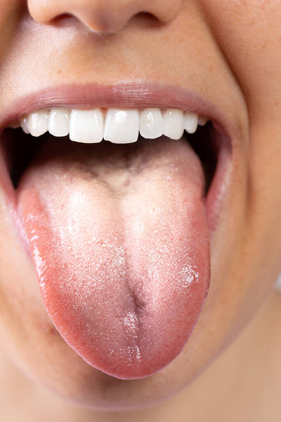 Een extreem close-up zicht op de tong van een jonge blanke dame die lijdt aan orale candidiasis. Witte harige tong, een veel voorkomend symptoom van een schimmelinfectie in de mond. - Foto, afbeelding