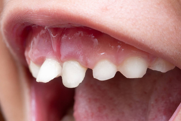 Krumme Zähne im Kindermund - Foto, Bild