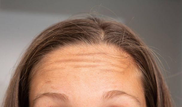 A closeup view on the forehead and hairline of a young Caucasian woman with light brown hair and tanned skin. Wrinkles are seen in the forehead. - Foto, Imagem