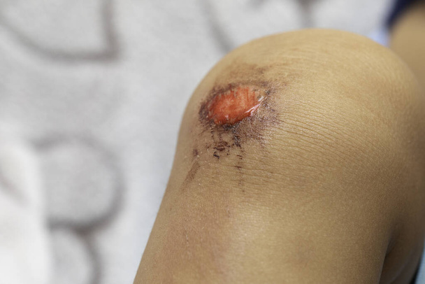 Lesioni ai bambini - doloroso incidente alla ferita al ginocchio
 - Foto, immagini