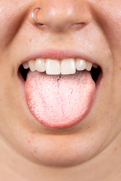 Man sieht ein kaukasisches Mädchen um die dreißig mit einer durchbohrten Nase aus nächster Nähe, die ihre Zunge herausstreckt, um einen dicken weißen Belag zu offenbaren. Ein häufiges Anzeichen für eine orale Soor-Infektion. - Foto, Bild