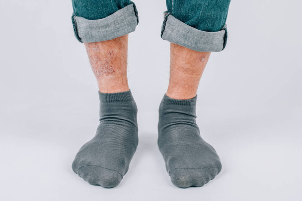 Nahaufnahme der Beine eines Mannes mit chronischer Schuppenflechte auf weißem Hintergrund - Foto, Bild