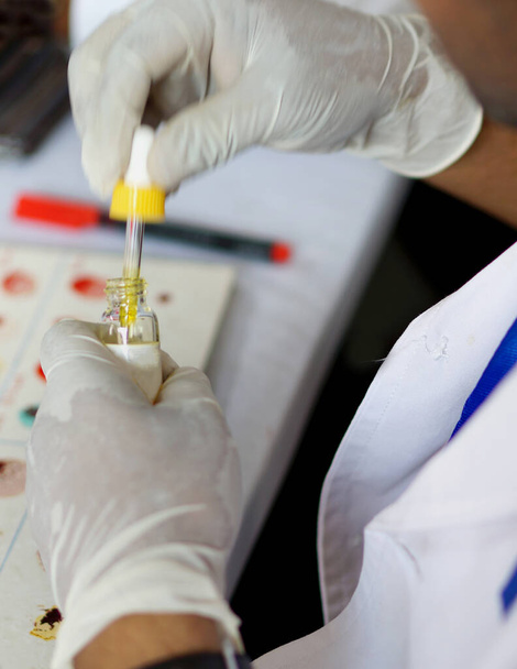 Técnico de laboratório adiciona reagente à amostra de sangue para descobrir o grupo sanguíneo da amostra, em um hospital
 - Foto, Imagem