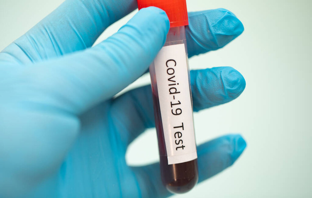 Тестова трубка з зразком крові для тесту на Ковід-19, новий коронавірус 2019, знайдений в Ухані, Китай. - Фото, зображення