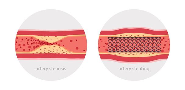Stenting sick human artery - Vektor, obrázek