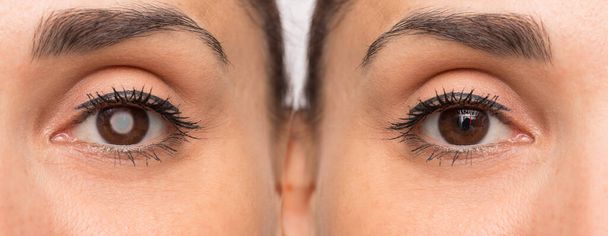 Female eyes before and after surgery with and without cataract - 写真・画像
