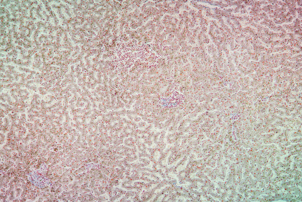 Tejido de hemosiderosis bajo el microscopio 100x
 - Foto, Imagen