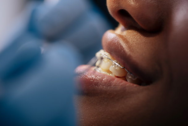 selective focus of smiling african american woman in braces  - Foto, immagini