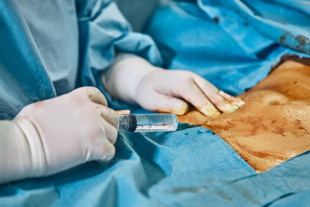 Косметическая липосакция в операционной, показывающая руки хирурга и канюлю. Современная медицина, пластическая хирургия. Здоровье красоты
. - Фото, изображение
