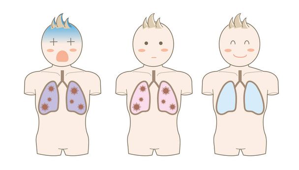 Coronavirus - Illustration du poumon
 - Vecteur, image