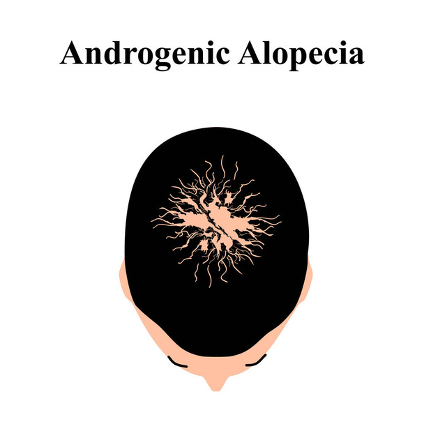 Alopecia haar. Kaalheid van haar op het hoofd. Androgene alopecia. Infografieën. Vectorillustratie op geïsoleerde achtergrond. - Vector, afbeelding