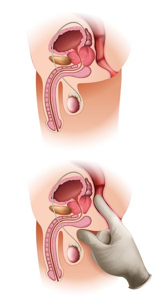 Prostate Cancer - Vector, Image