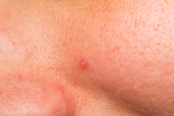 foto de cerca de una cara de mujer con acné
 - Foto, Imagen
