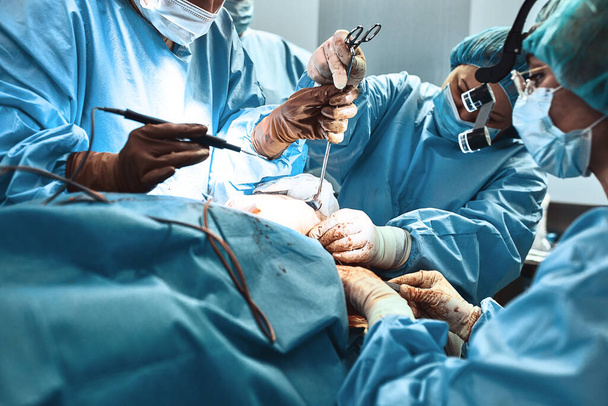 Ein Team von Chirurgen kämpft um das Leben, eine echte Operation, echte Emotionen. Intensivmediziner kämpfen um das Leben des Patienten. Leben retten, der Kampf ums Leben. - Foto, Bild