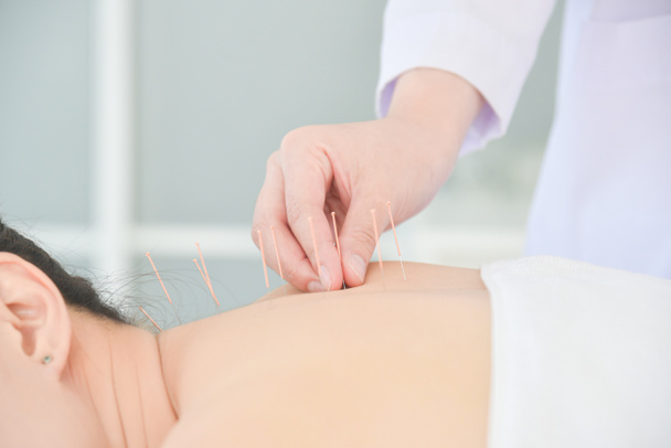 Ruce terapeuta dělat akupunkturu na zádech pacienta, Alternativní medicína koncept. - Fotografie, Obrázek