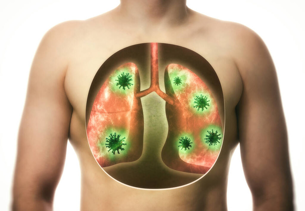 Illustratives Bild von Lungenschäden durch das Coronavirus covid-19. Menschliche Anatomie. Konzept - Foto, Bild
