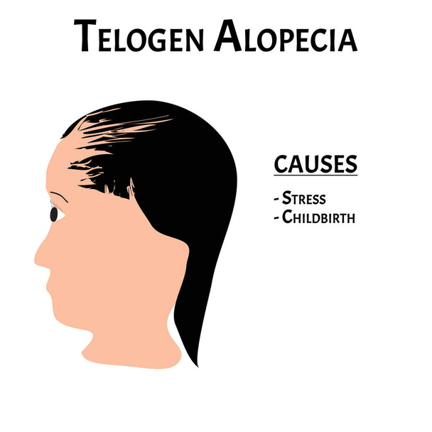 Hiustenlähtö. Hiusten kaljuuntuminen päässä. Telogeeni Hiustenlähtö aiheuttaa. Infografiikkaa. Vektorin kuva eristetyllä taustalla
. - Vektori, kuva