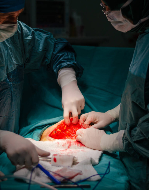 Concentrated doctor and assistant  during a hysterectomy operation in a hospital. Opening the abdomen during hysterectomy surgery - Photo, Image