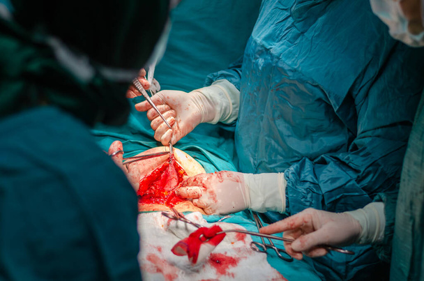子宮摘出手術でステッチで腹部組織をステッチ - 写真・画像