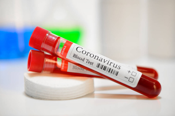 COVID-19 test and laboratory sample of blood testing for diagnosis coronavirus infection  - Photo, image