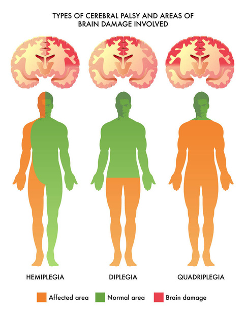  τύποι απεικόνισης φορέα εγκεφαλικής παράλυσης - Διάνυσμα, εικόνα
