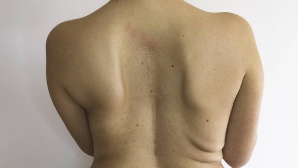 Scoliosis -脊髄手術の傷跡のある女性の裸の背中. - 写真・画像