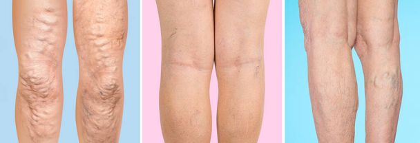The old age and sick of a woman. Varicose veins on a legs of woman. The varicosity, spider veins, edema, illness concept. - Photo, Image
