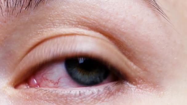 Gros plan d'un œil rouge sanguin sévère. Blepharite virale, conjonctivite, adénovirus. Œil irrité ou infecté. Virus de la couronne
 - Séquence, vidéo