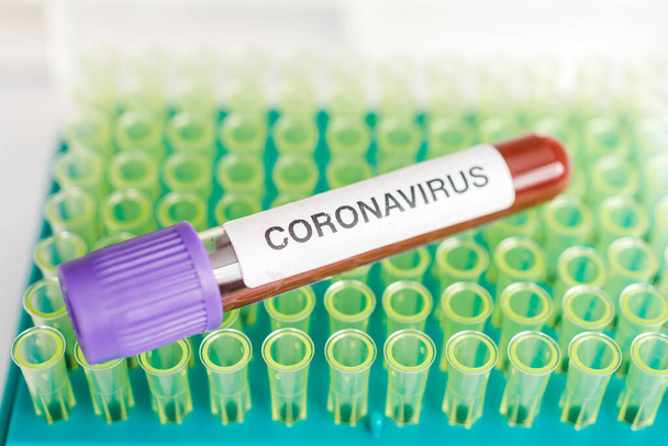 COVID-19 test tube and laboratory sample of blood testing for diagnosis new Corona virus infection(novel corona virus disease from hospital background. Pandemic infectious concept - Foto, Bild