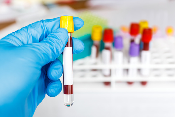 COVID-19 test tube and laboratory sample of blood testing for diagnosis new Corona virus infection(novel corona virus disease from hospital background. Pandemic infectious concept - Photo, Image