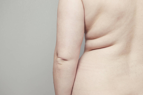 Parte posterior del cuerpo grueso desnudo femenino con pliegues en la piel. Obesidad y enfermedad terminal
 - Foto, Imagen