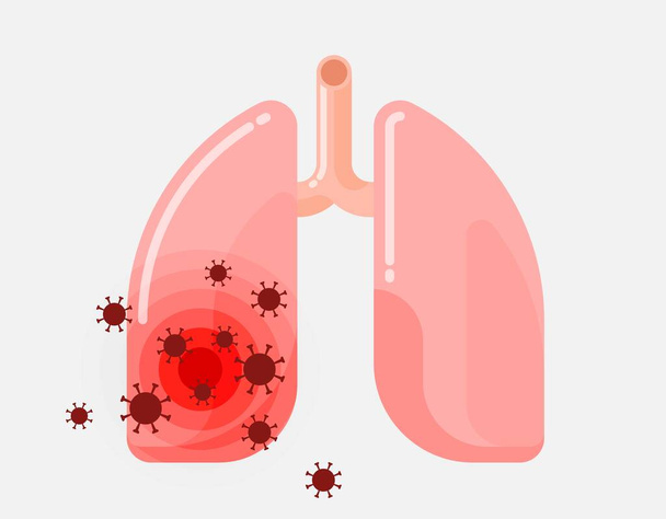 Menselijke longen geïnfecteerd door het virus - Vector, afbeelding