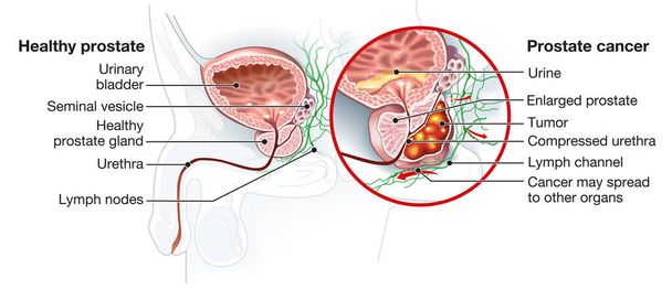 Medically Illustration showing healthy prostate gland and prostate cancer, - Photo, Image