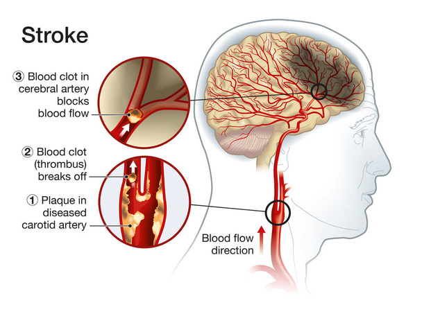 Ilustración que muestra placa en la arteria carótida, coágulo de sangre rompiendo y bloqueando el flujo sanguíneo
 - Foto, imagen