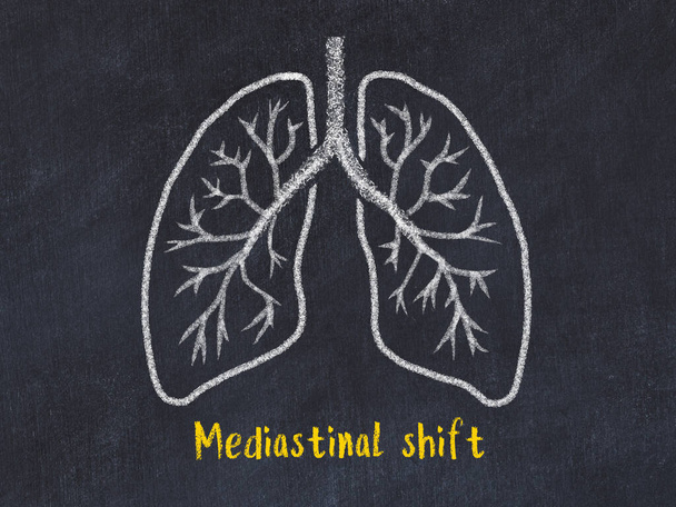 Έννοια της μάθησης ασθενειών των πνευμόνων. Σχέδιο κιμωλίας πνευμόνων με επιγραφή - Φωτογραφία, εικόνα