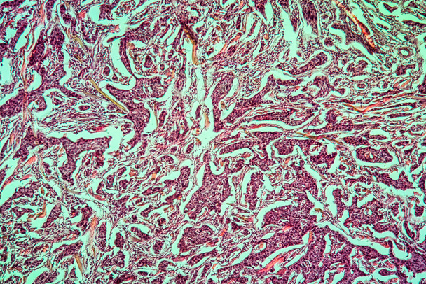 Breast cancer of the woman diseased tissue 100x - Photo, Image