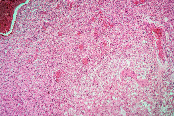 Glioma tumor with diseased tissue 100x - Photo, Image