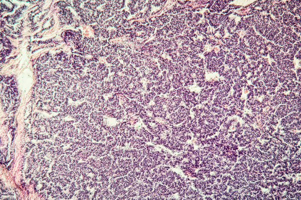 Métastases tumeur tissu malade 100x
 - Photo, image