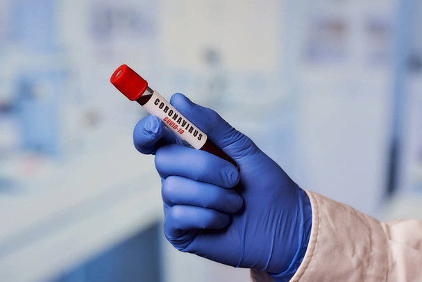Lääkärin käsi sinisessä kertakäyttöisessä lääketieteellisessä käsineessä, jolla on positiivinen koronavirus (COVID-19) verikoe laboratoriossa
. - Valokuva, kuva